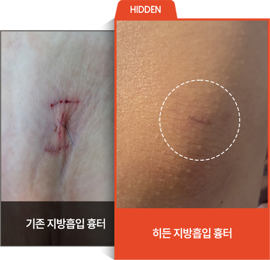 히든흉터 이미지